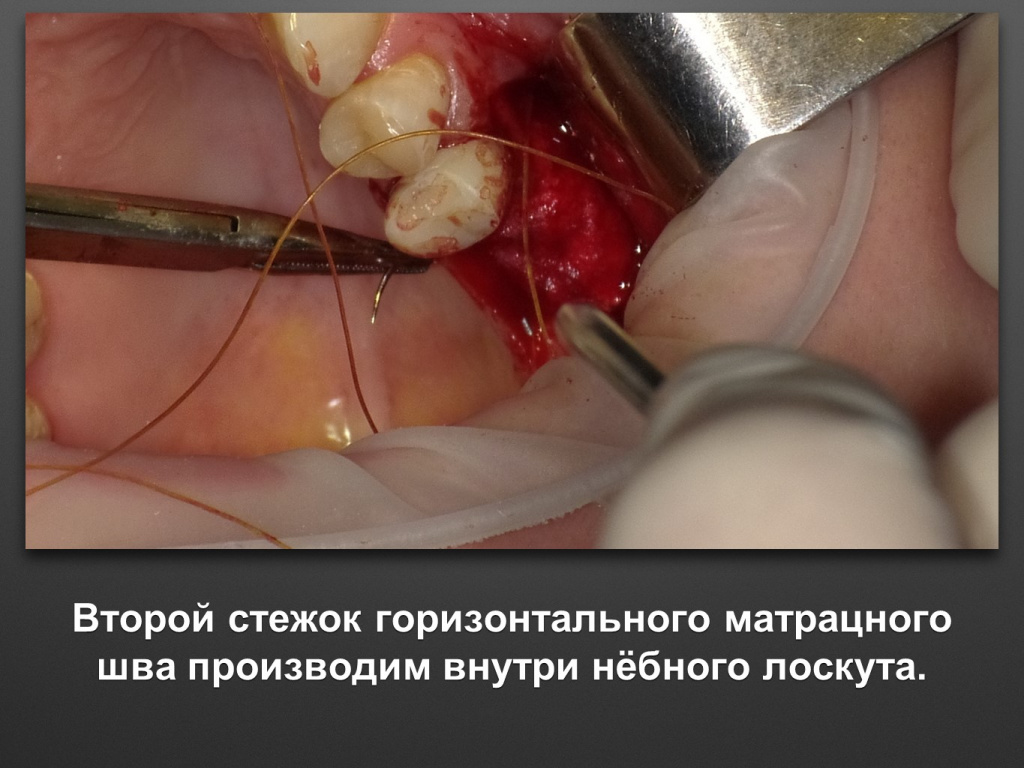 Биоимплант ГАП. Имплантация в дистальном отделе