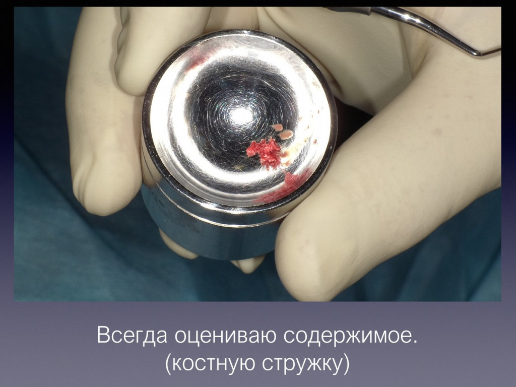Постановка имплантата после презервации