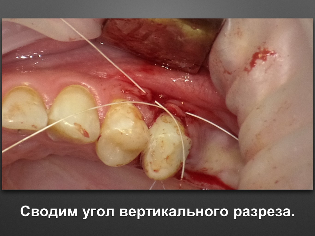 Биоимплант ГАП. Имплантация в дистальном отделе