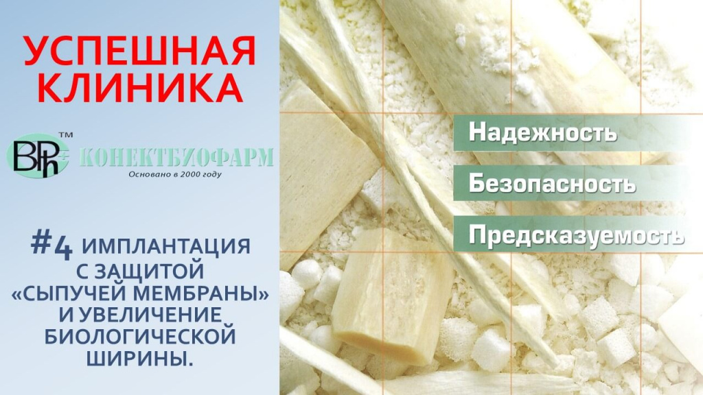 [ВИДЕО]ИМПЛАНТАЦИЯ С ЗАЩИТОЙ «СЫПУЧЕЙ МЕМБРАНЫ» И УВЕЛИЧЕНИЕ БИОЛОГИЧЕСКОЙ ШИРИНЫ.