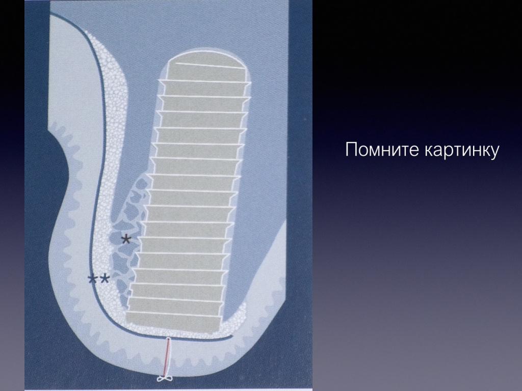 Принцип направленной костной регенерации