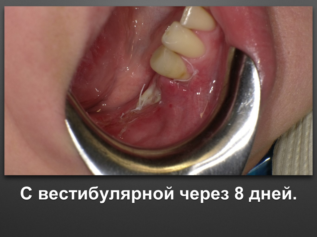 Горизонтальное увеличение альвеолярного отростка
