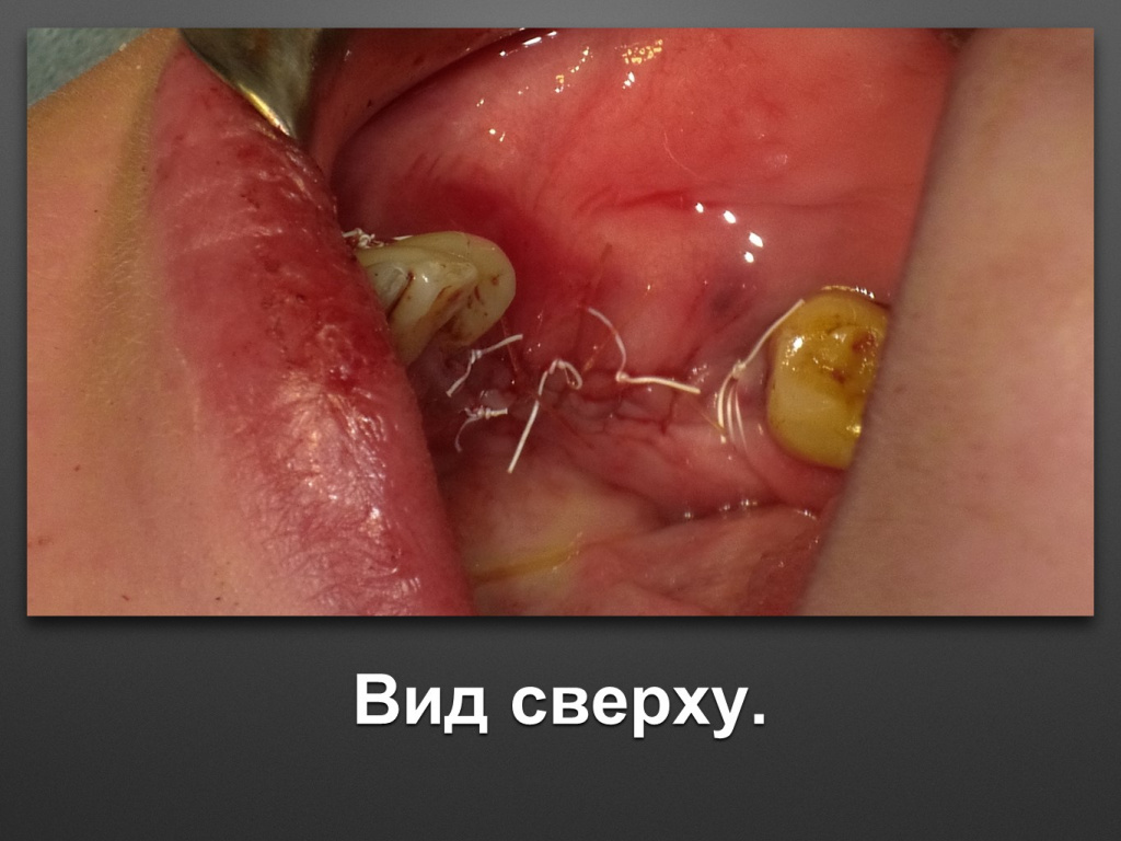 Горизонтальное увеличение альвеолярного отростка
