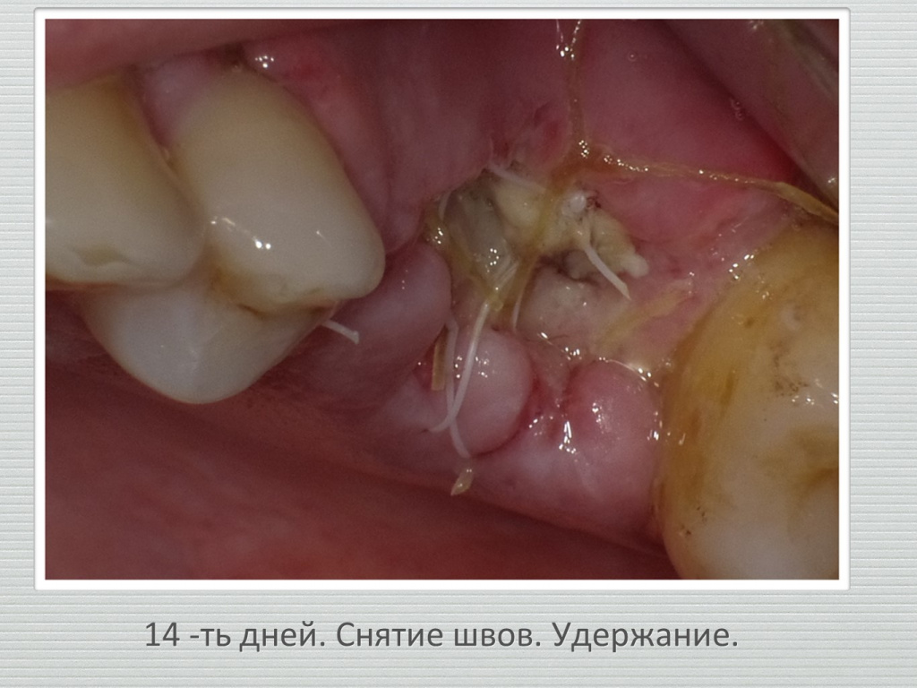 Ранозаживление