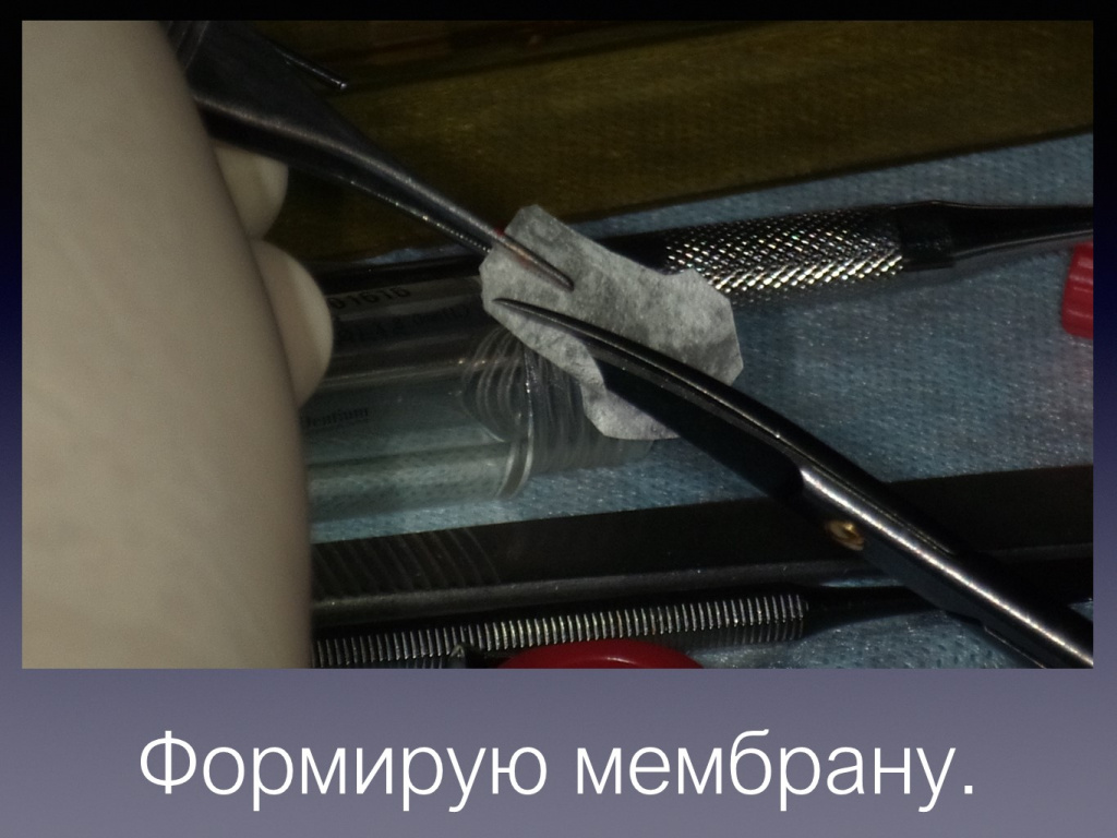 Постановка имплантата после презервации