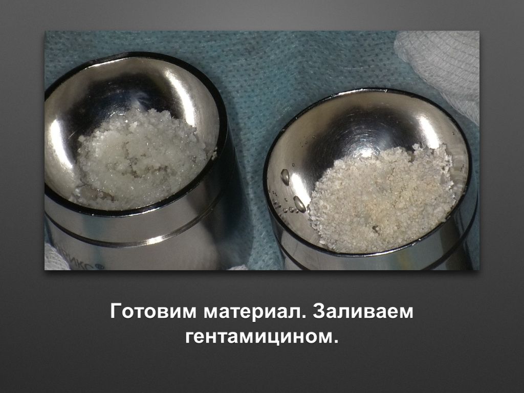 Горизонтальное увеличение альвеолярного отростка
