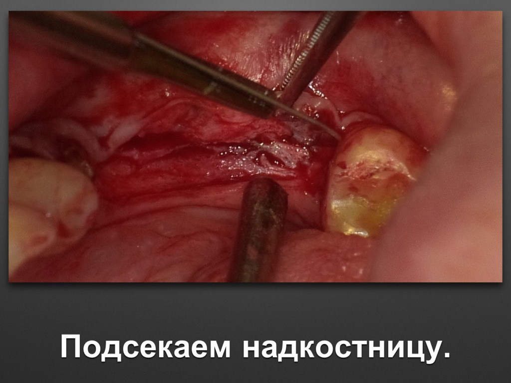 Горизонтальное увеличение альвеолярного отростка