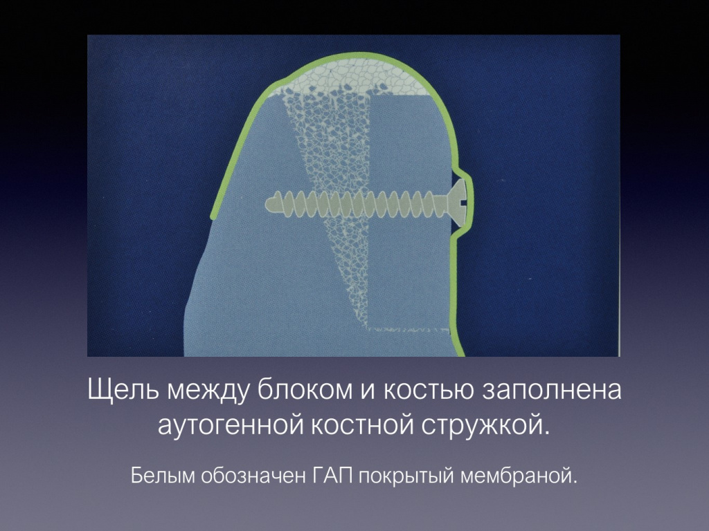 Принцип направленной костной регенерации