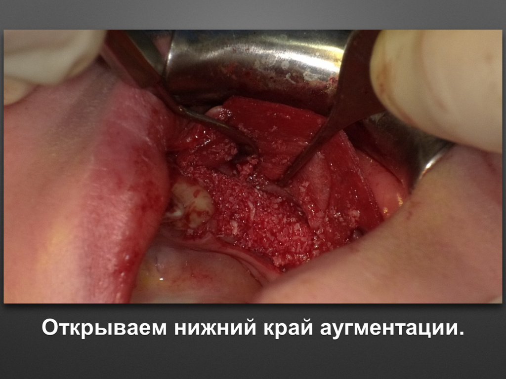 Горизонтальное увеличение альвеолярного отростка