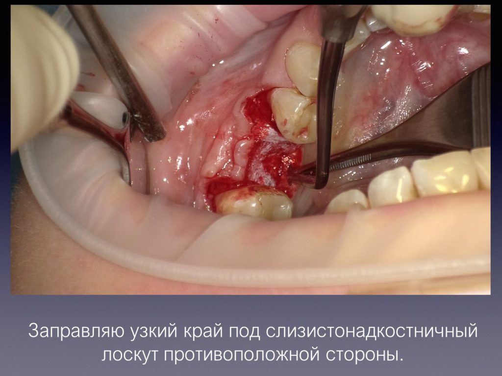 Постановка имплантата после презервации