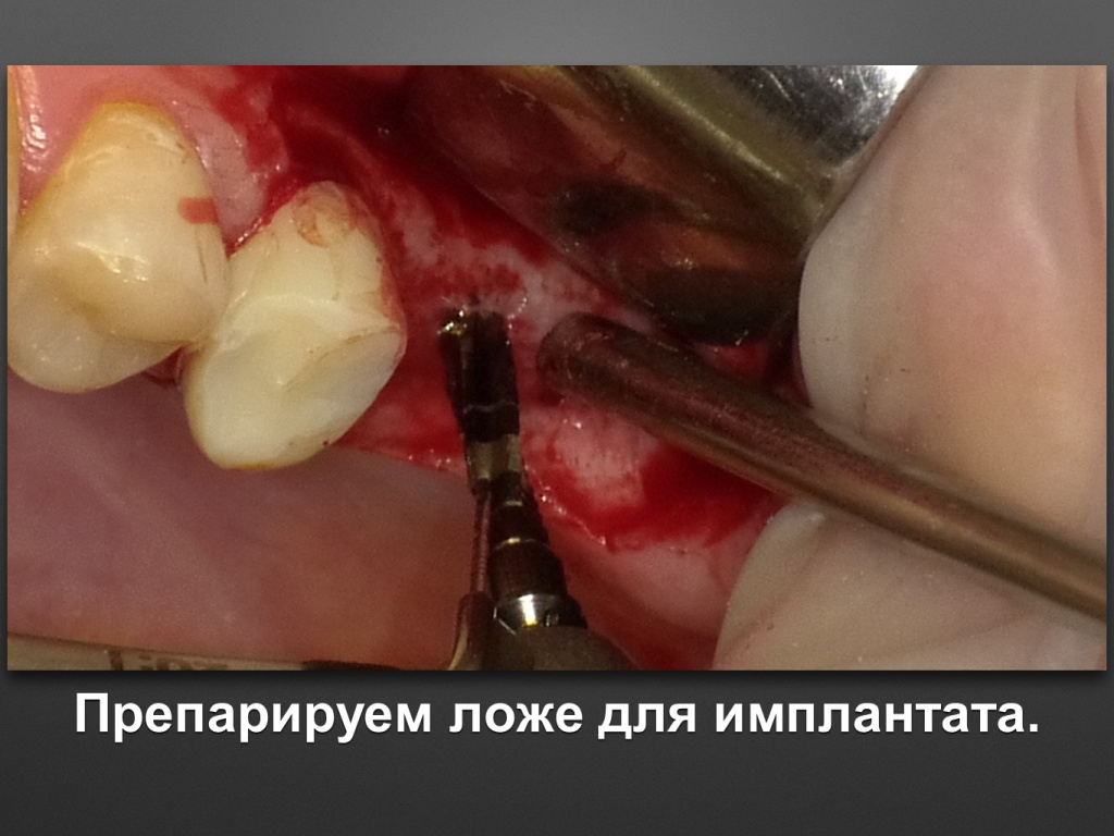 Биоимплант ГАП. Имплантация в дистальном отделе