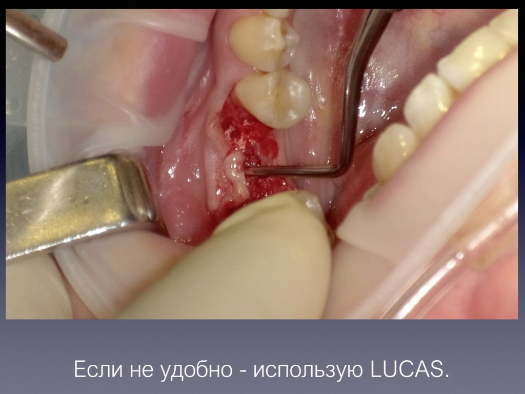 Постановка имплантата после презервации