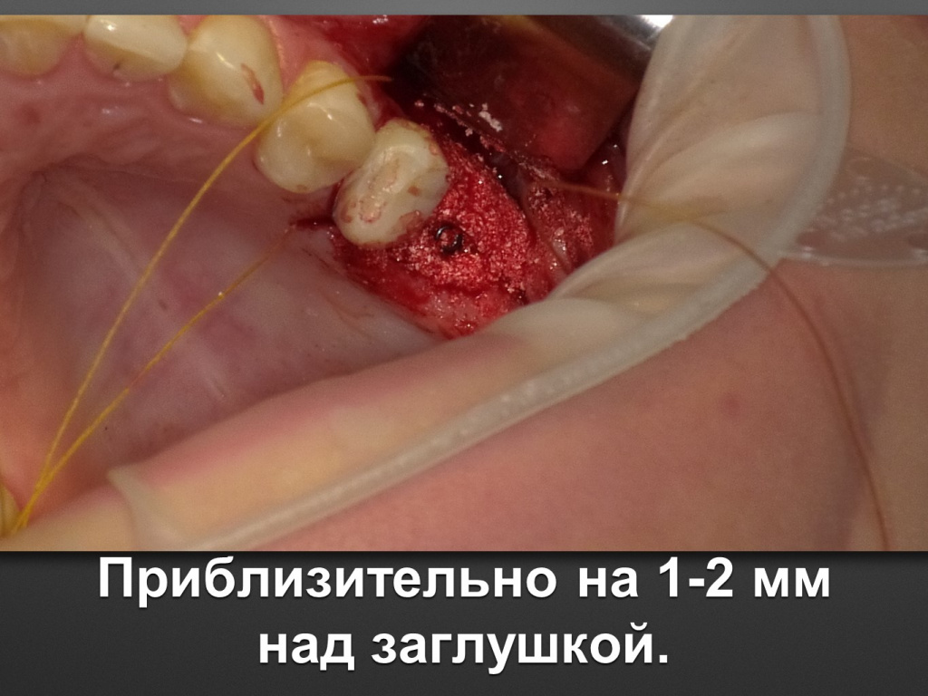 Биоимплант ГАП. Имплантация в дистальном отделе