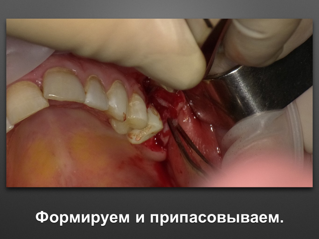 Биоимплант ГАП. Имплантация в дистальном отделе