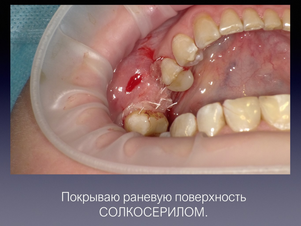 Постановка имплантата после презервации