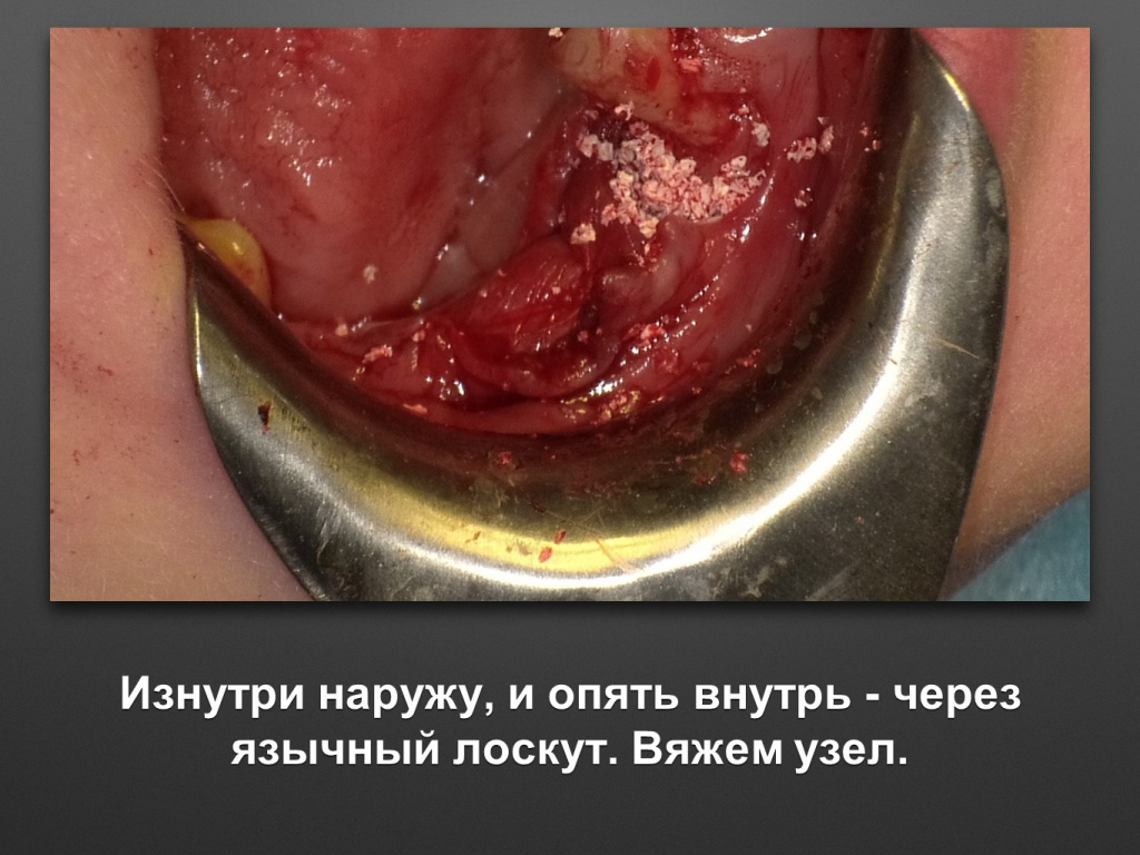 Горизонтальное увеличение альвеолярного отростка