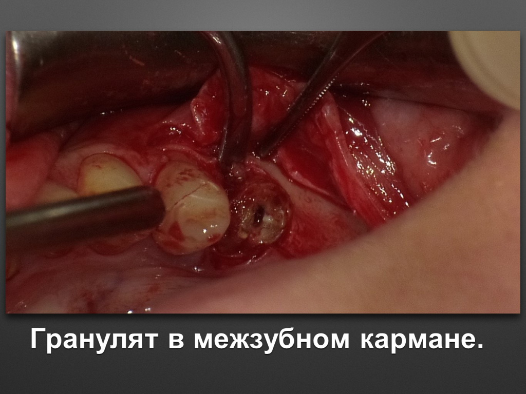 Горизонтальное увеличение альвеолярного отростка