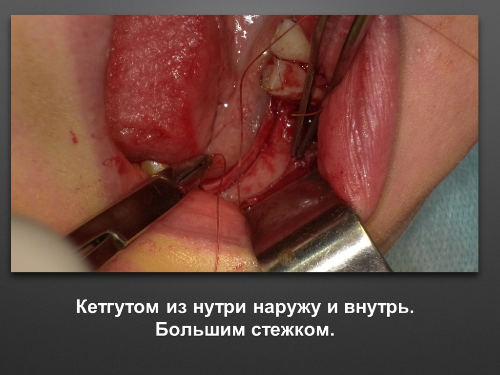 Горизонтальное увеличение альвеолярного отростка