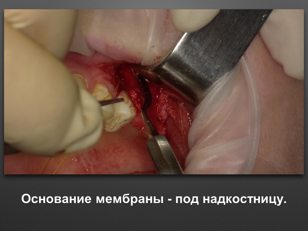 Биоимплант ГАП. Имплантация в дистальном отделе