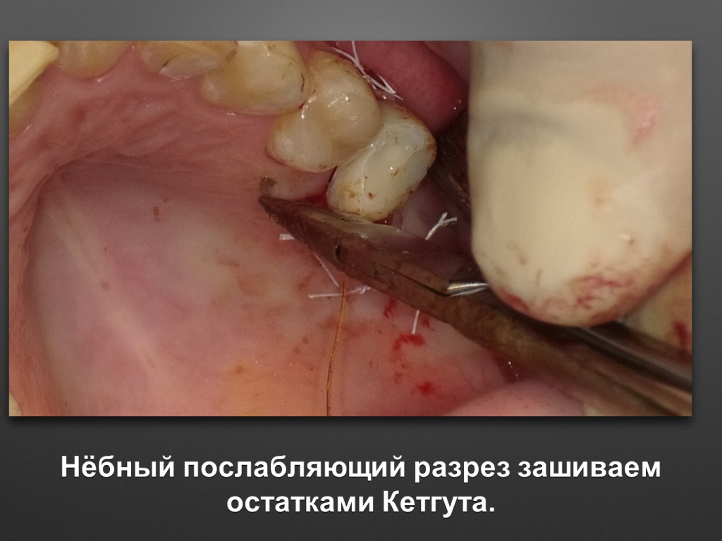 Биоимплант ГАП. Имплантация в дистальном отделе