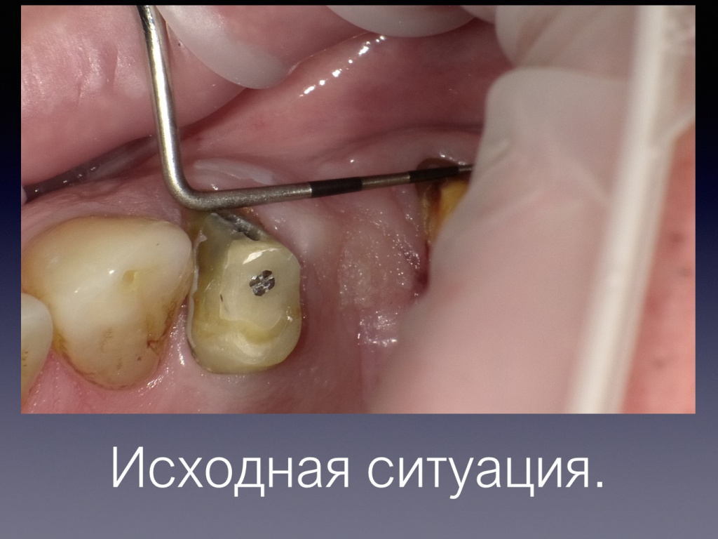 Постановка импланта