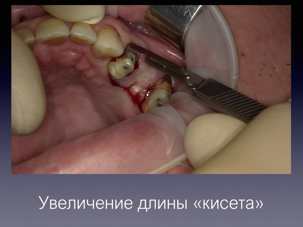 Постановка импланта