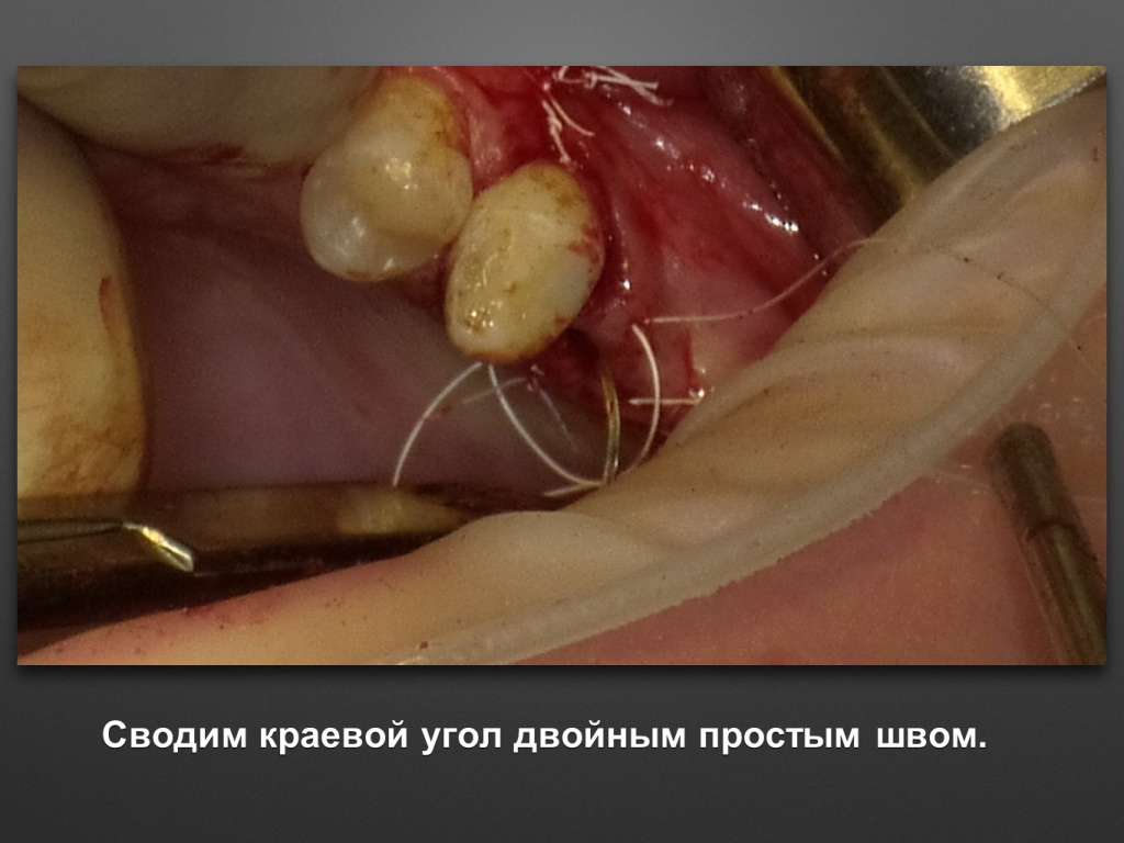 Биоимплант ГАП. Имплантация в дистальном отделе