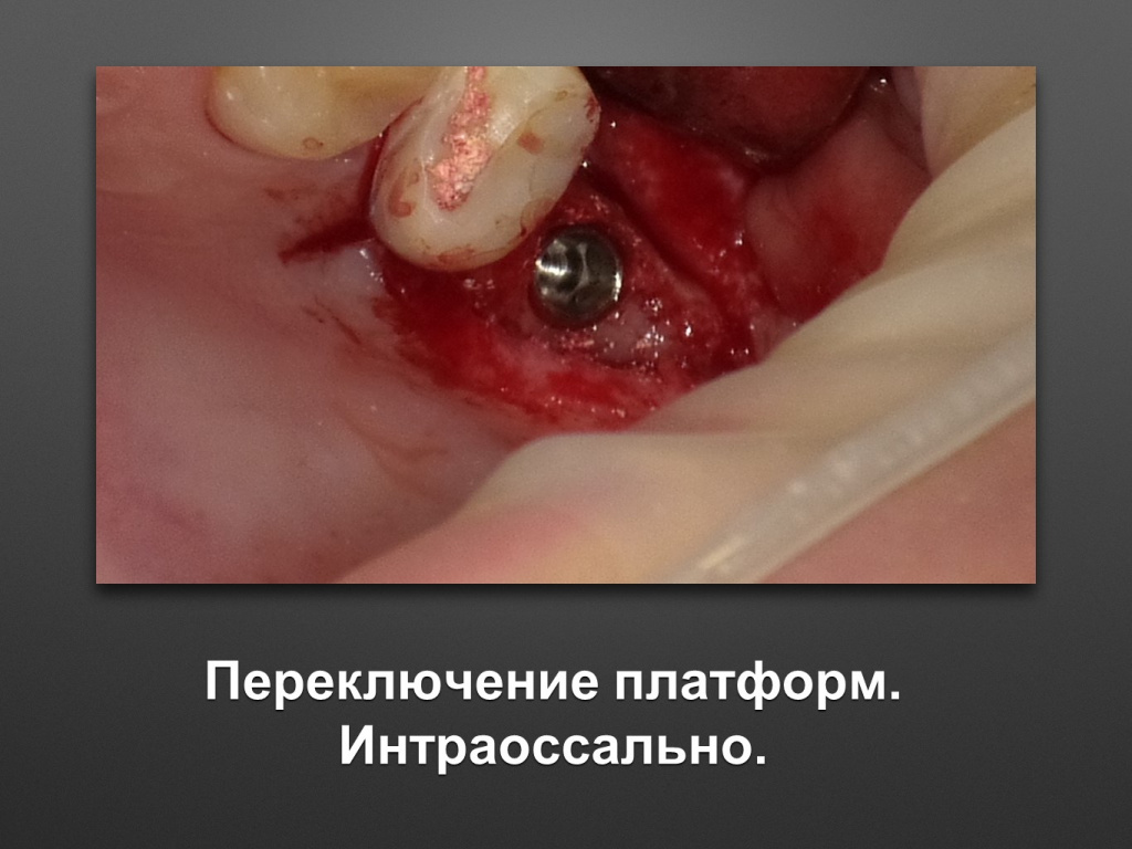 Биоимплант ГАП. Имплантация в дистальном отделе