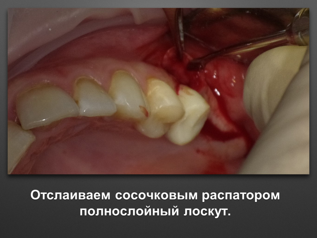 Биоимплант ГАП. Имплантация в дистальном отделе
