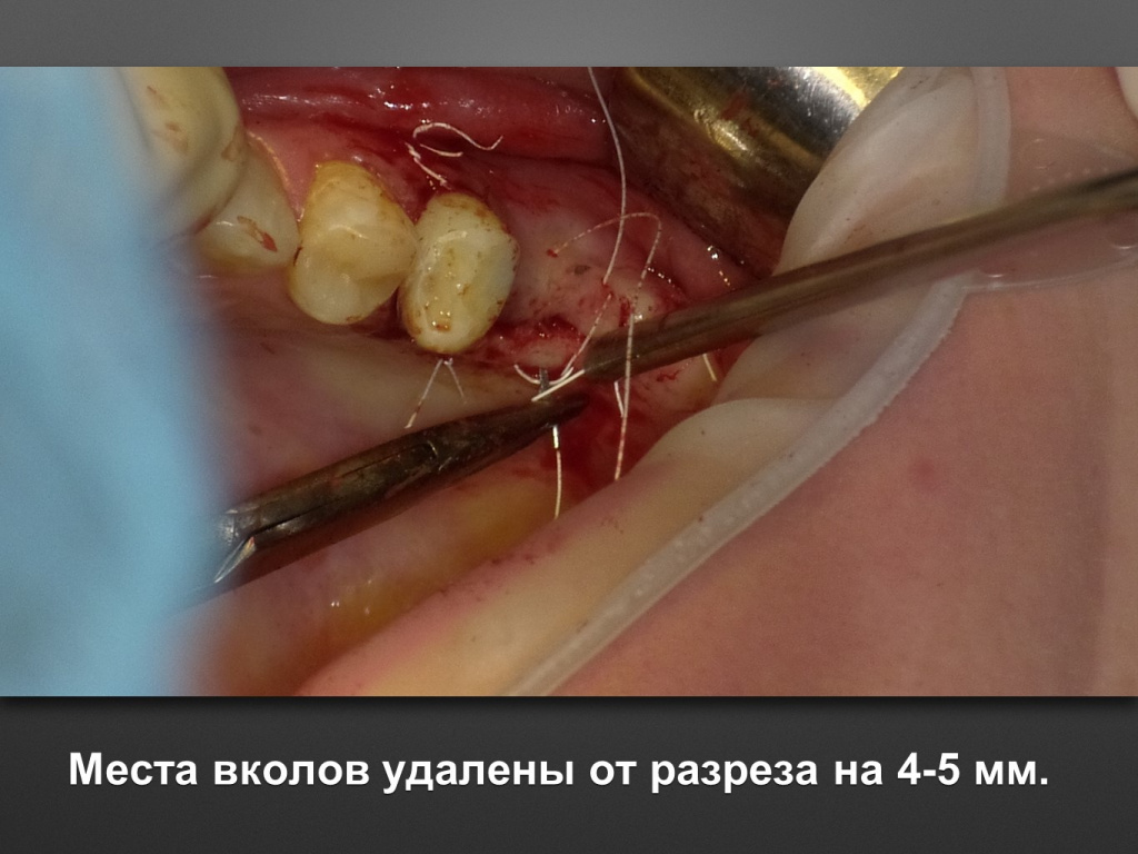 Биоимплант ГАП. Имплантация в дистальном отделе