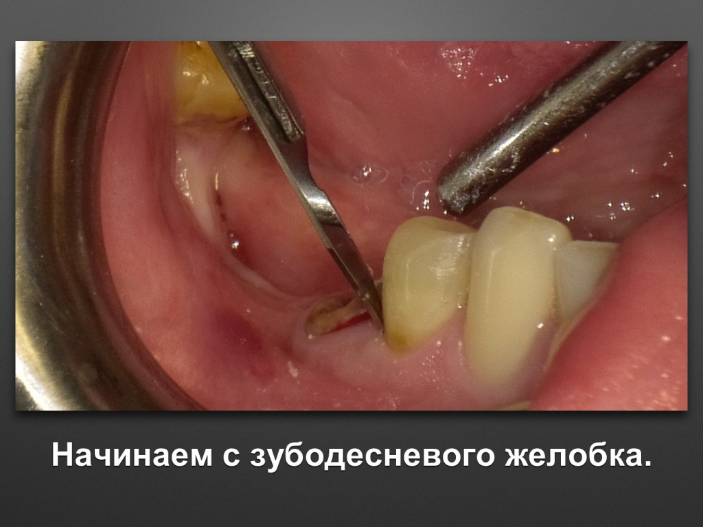 Горизонтальное увеличение альвеолярного отростка