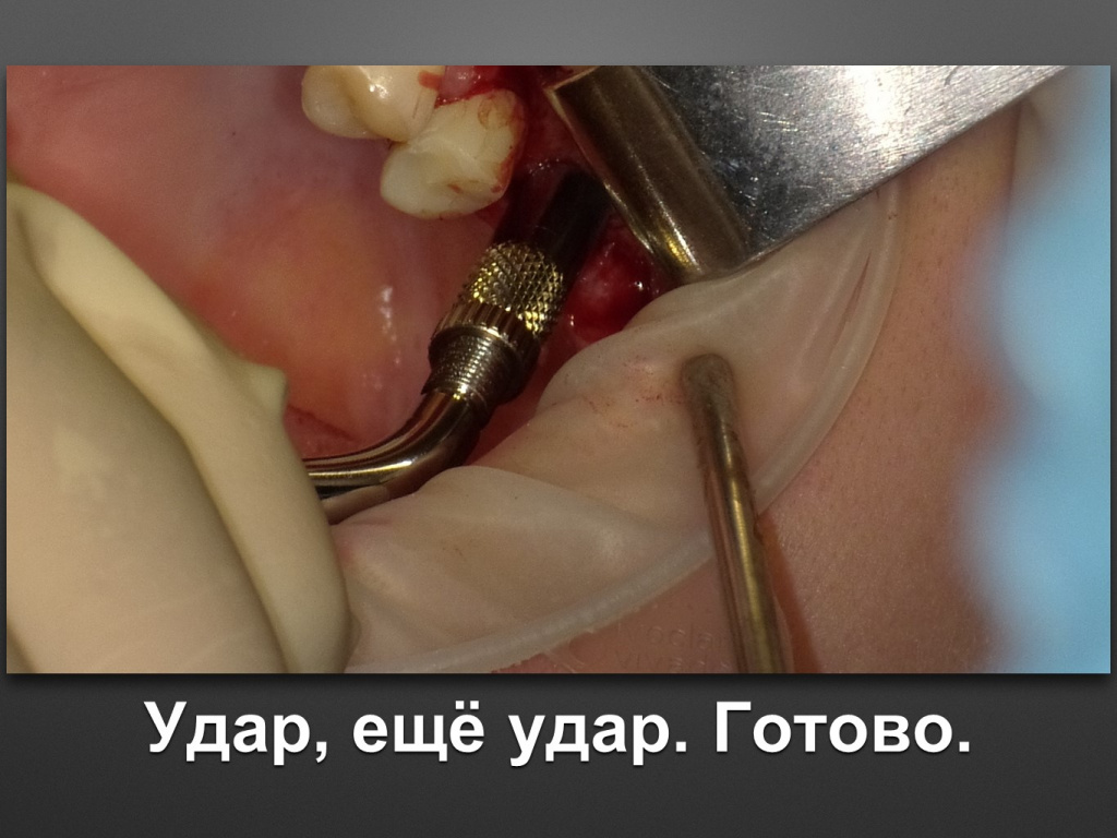 Биоимплант ГАП. Имплантация в дистальном отделе