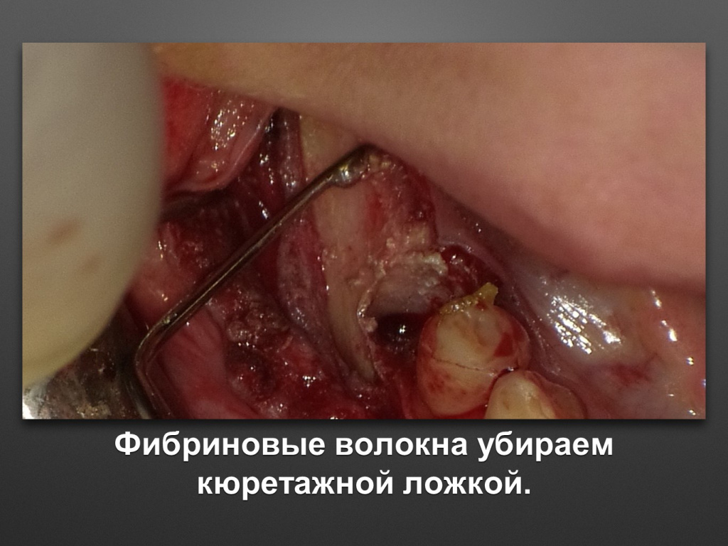 Горизонтальное увеличение альвеолярного отростка
