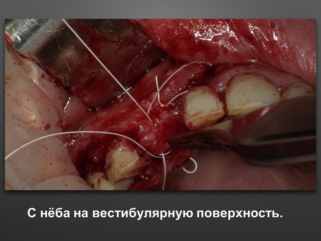 БАЛДЕЙ НОГА