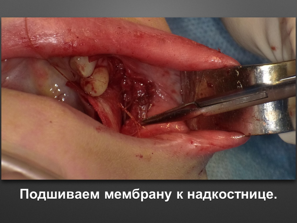 Горизонтальное увеличение альвеолярного отростка