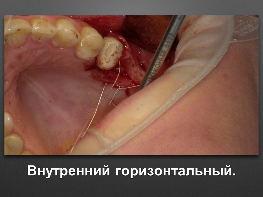 Биоимплант ГАП. Имплантация в дистальном отделе