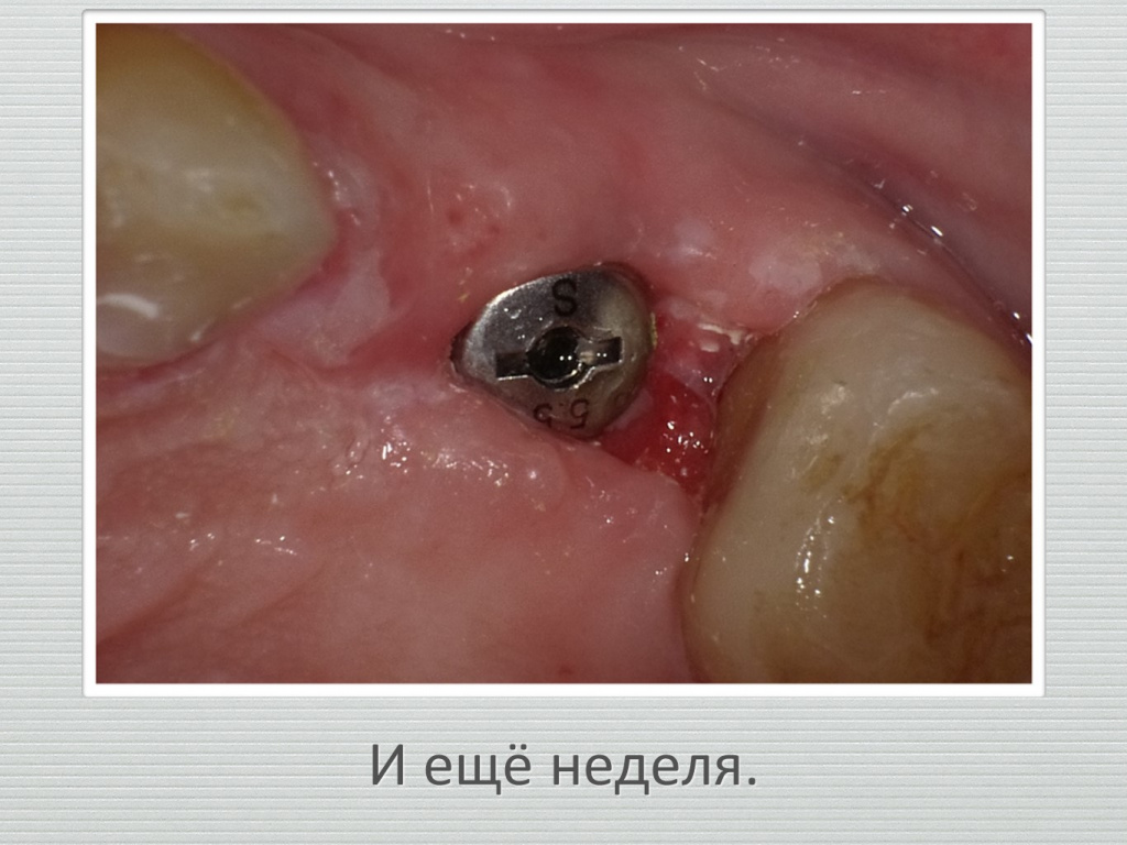 Ранозаживление