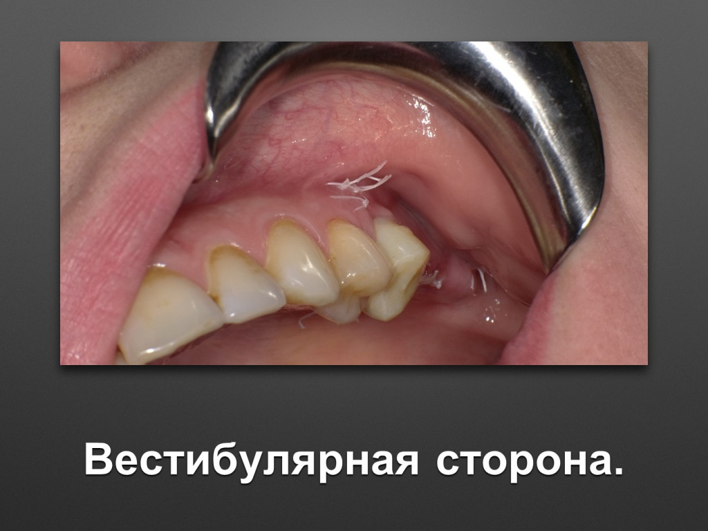 Биоимплант ГАП. Имплантация в дистальном отделе