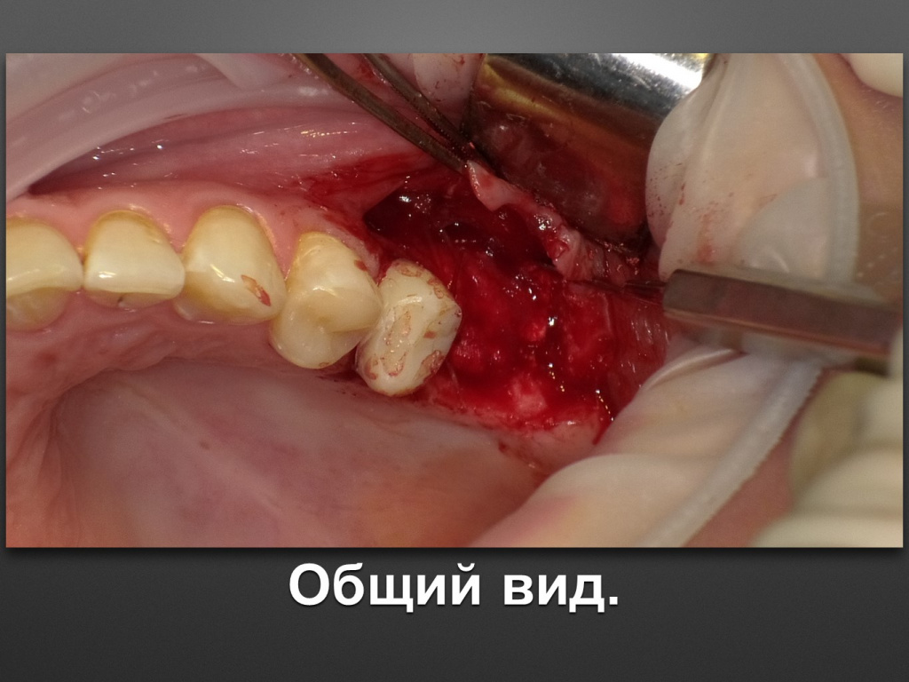 Биоимплант ГАП. Имплантация в дистальном отделе