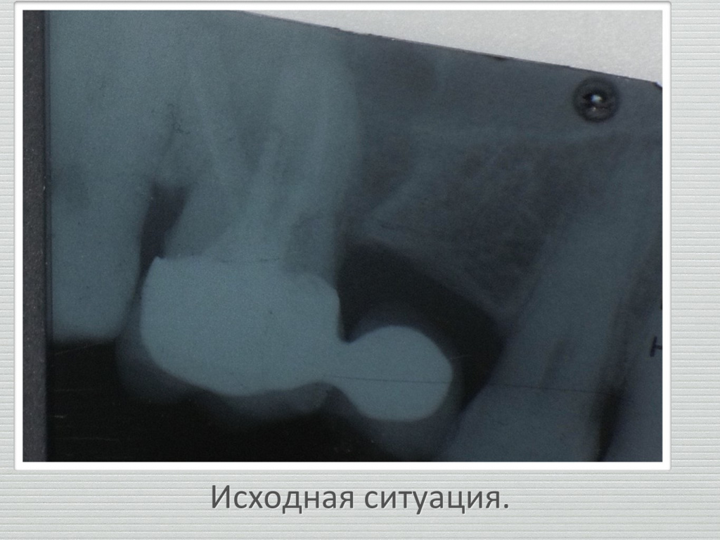 Ранозаживление