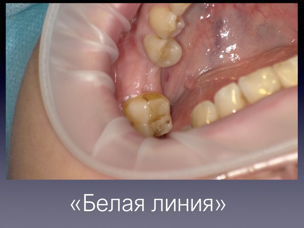 Постановка имплантата после презервации