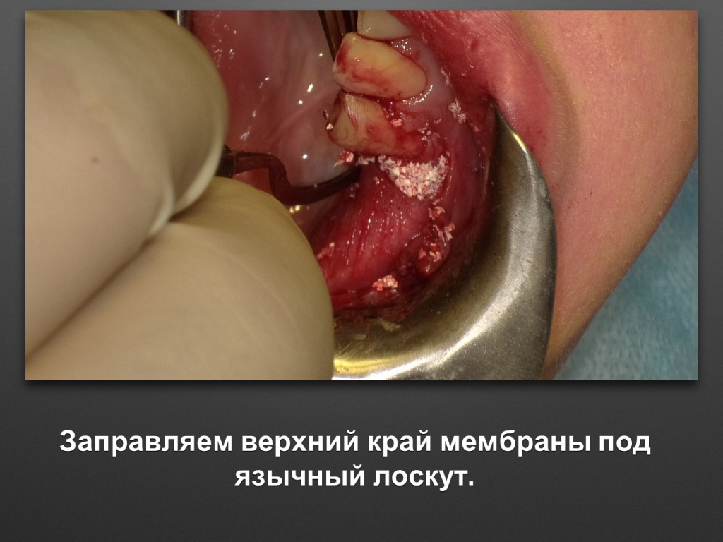 Горизонтальное увеличение альвеолярного отростка