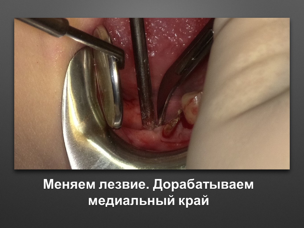 Горизонтальное увеличение альвеолярного отростка