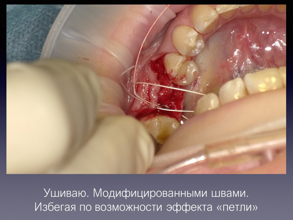 Постановка имплантата после презервации