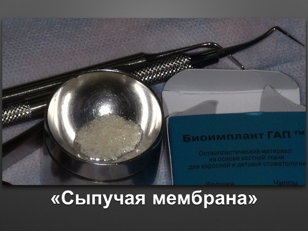 Биоимплант ГАП. Имплантация в дистальном отделе
