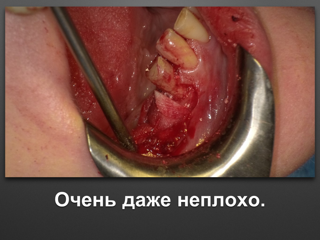 Горизонтальное увеличение альвеолярного отростка