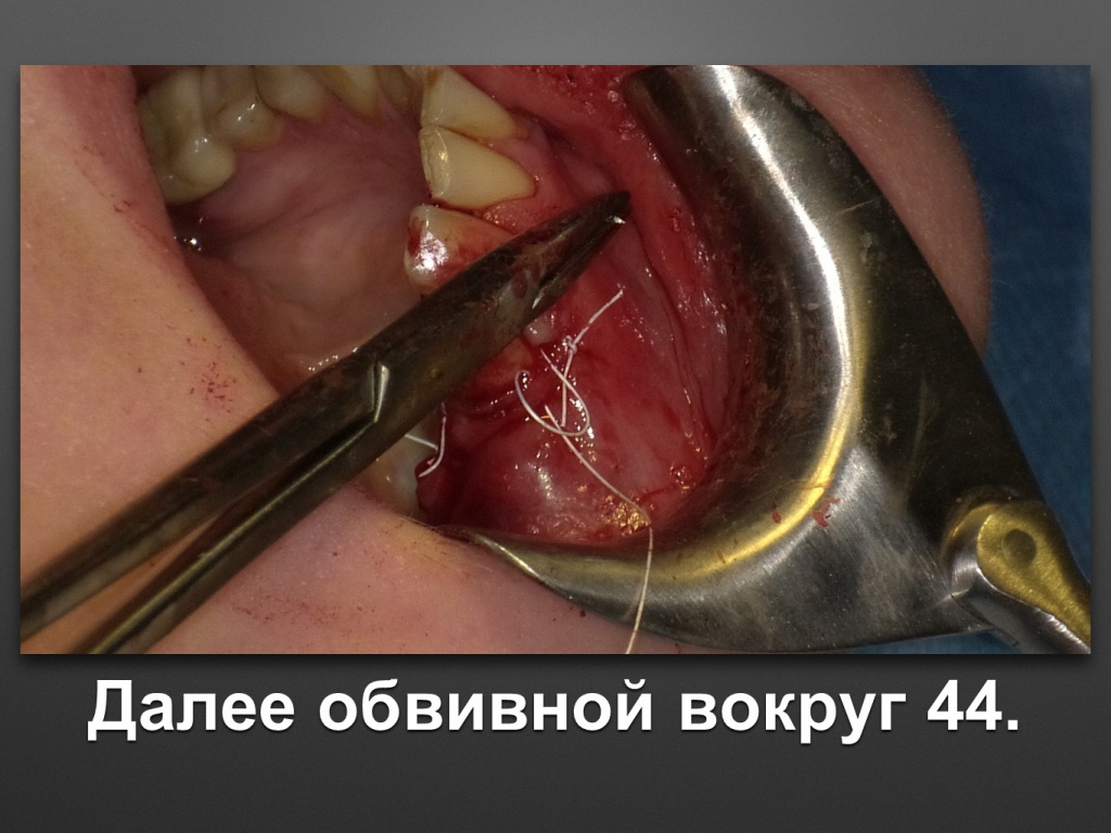 Горизонтальное увеличение альвеолярного отростка