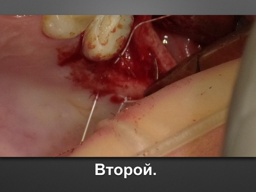 Биоимплант ГАП. Имплантация в дистальном отделе