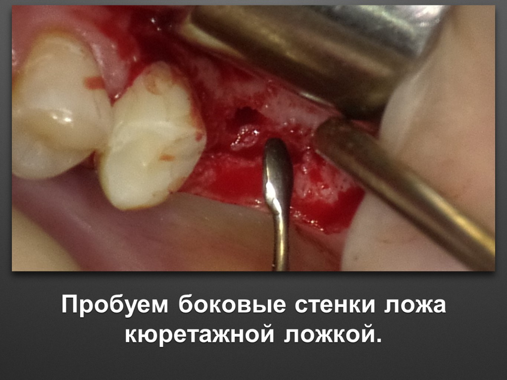 Биоимплант ГАП. Имплантация в дистальном отделе