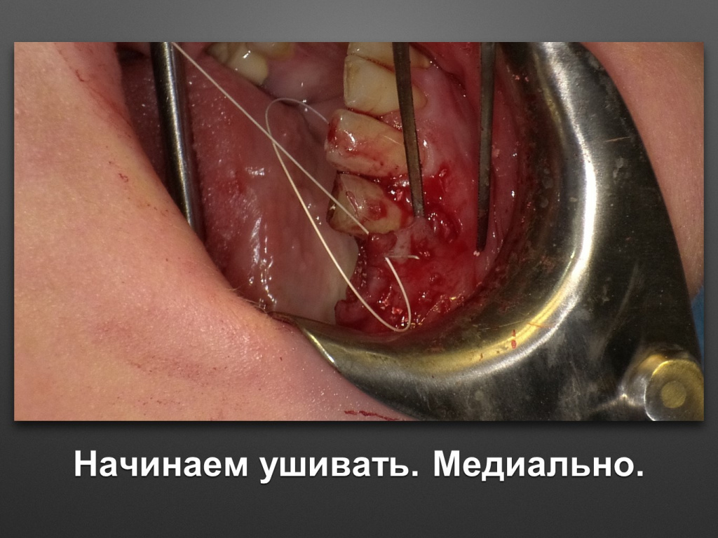 Горизонтальное увеличение альвеолярного отростка